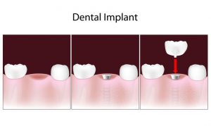 dental implants Parker